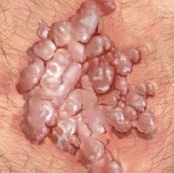 Picture of Genital Warts