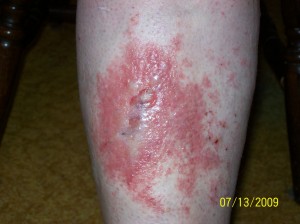 Here is my mom's spider bite a couple of days after starting the antibiotic and Medrol dose-pack.